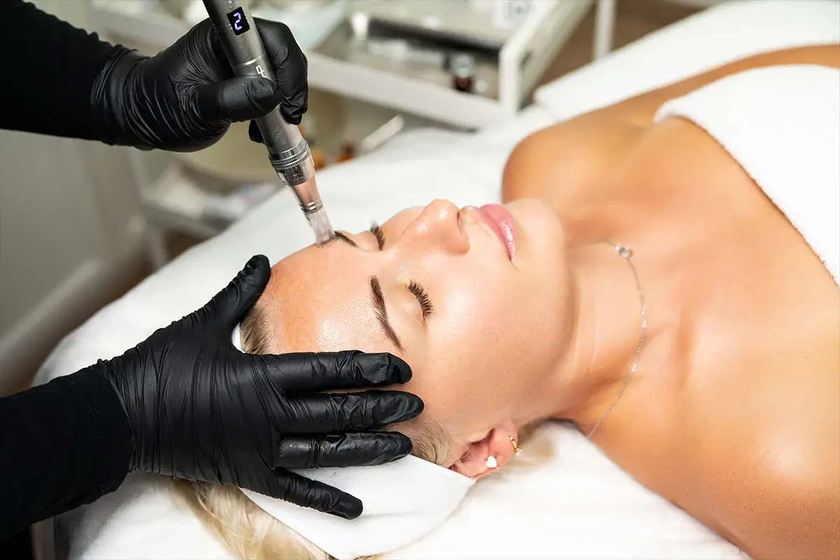 A person in black gloves performs a microneedling treatment on a woman's forehead as she lies on a white bed.