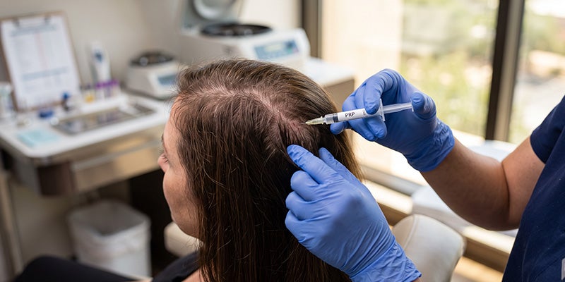 PRP for Hair Restoration