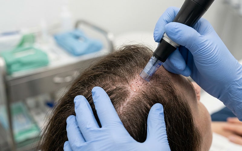 PRP Face and Scalp